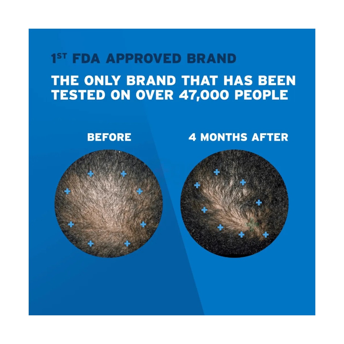 Men's Rogaine Hair Regrowth Treatment 5% Minoxidil Topical Aerosol 60g